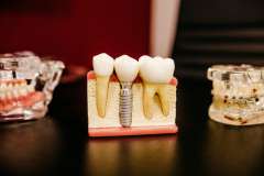 Implant zęba - zdjęcie partnera